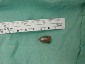 Israeli hospital removes bullet from Syrian child's neck. Photo: Rambam Hospital