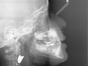 Israeli hospital removes bullet from Syrian child's neck. Photo: Rambam Hospital