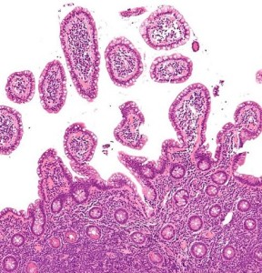 A micrograph of mantle cell lymphoma. Tel Aviv University (TAU) researchers have developed an innovative system that may treat the incurable blood cancer. Photo: Nephron via Wikimedia Commons.