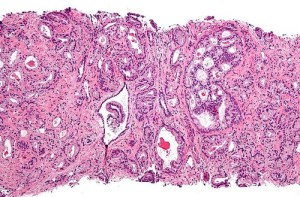 A prostate cancer micrograph. A drug invented by Israel’s Weizmann Institute of Science treats early-stage prostate cancer. Photo: Nephron via Wikimedia Commons. 