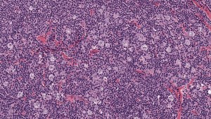 Lymph node biopsy showing Hodgkin lymphoma. Credit: Wikimedia Commons.